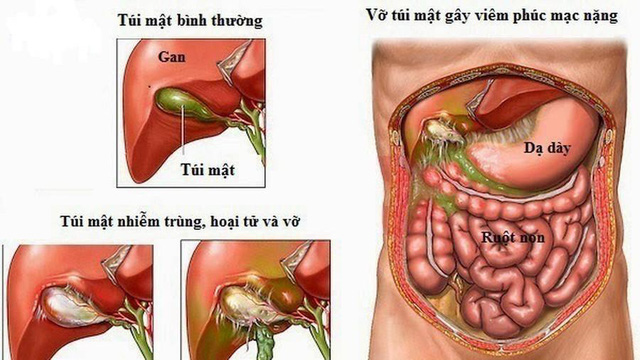 Viêm túi mật có thể gây biến chứng hoại tử túi mật