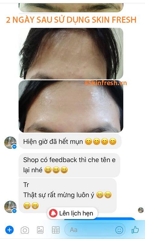 hướng dẫn cách trị mụn với Skin Fresh