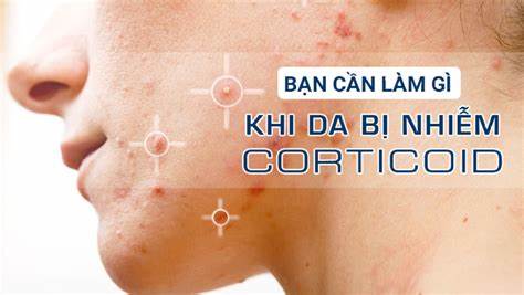 da mặt bị nhiễm corticoid